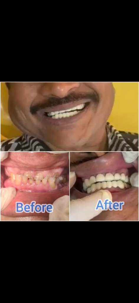 Immediate Loading All-on-4 Dental Implants